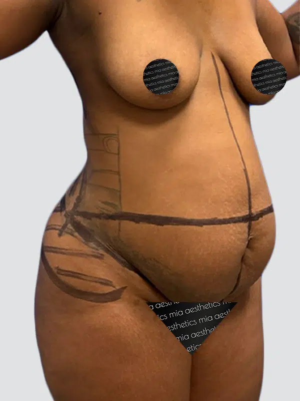 Tummy Tuck before photo – Mia Aesthetics