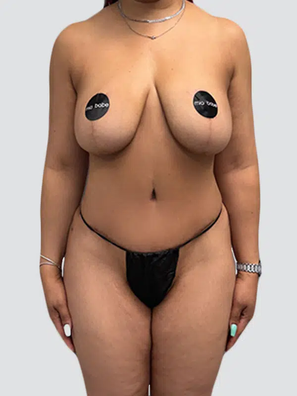 Tummy Tuck after photo – Mia Aesthetics