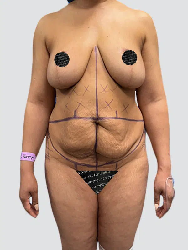 Tummy Tuck before photo – Mia Aesthetics