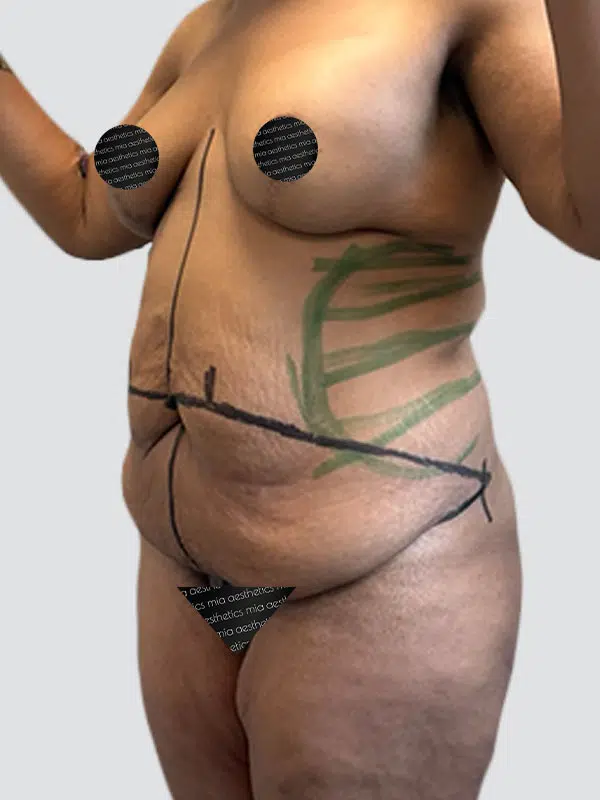 Tummy Tuck before photo – Mia Aesthetics