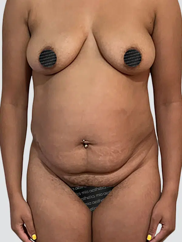Tummy Tuck before photo – Mia Aesthetics