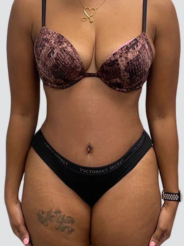 Tummy Tuck after photo – Mia Aesthetics