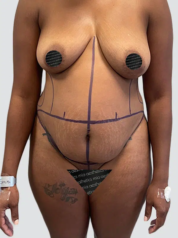 Tummy Tuck before photo – Mia Aesthetics