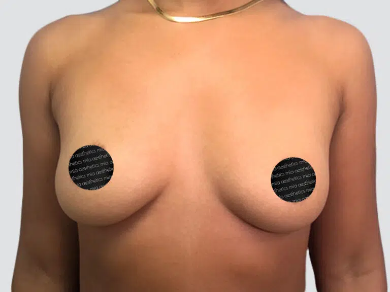 Breast Augmentation before photo – Mia Aesthetics