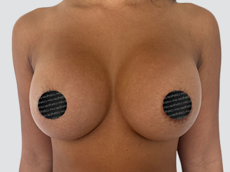 After Treatment – Case 2016 – Breast Augmentation – Set 1