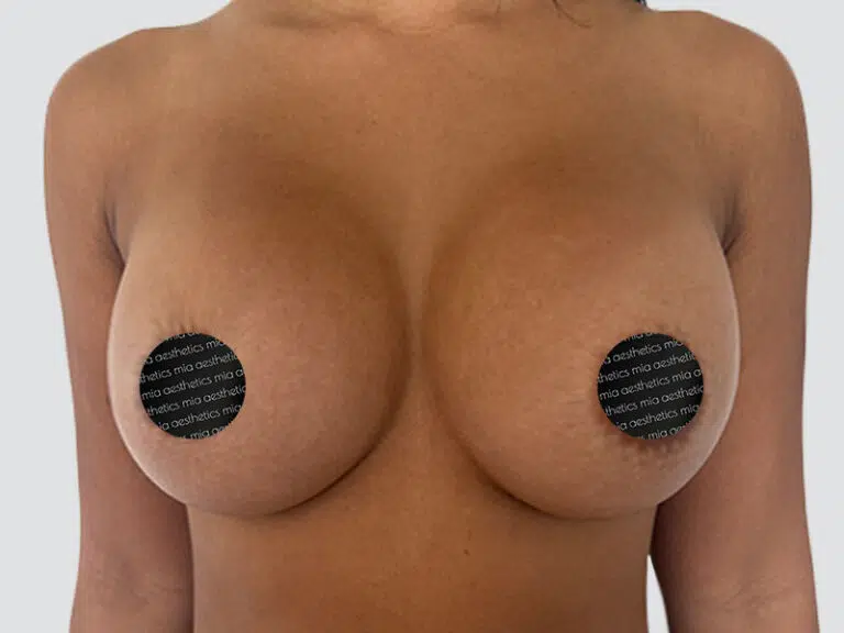 Breast Augmentation after photo – Mia Aesthetics