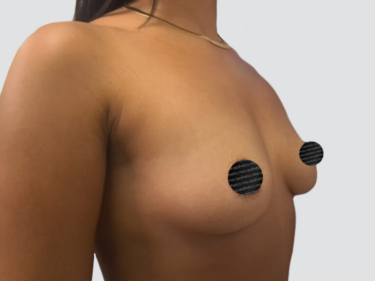 Before Treatment – Case 2016 – Breast Augmentation – Set 2