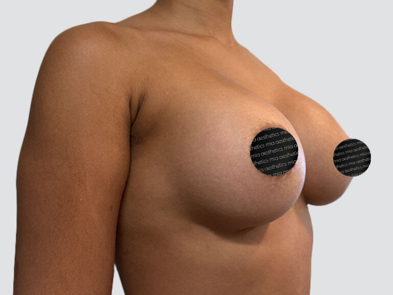 After Treatment – Case 2016 – Breast Augmentation – Set 2