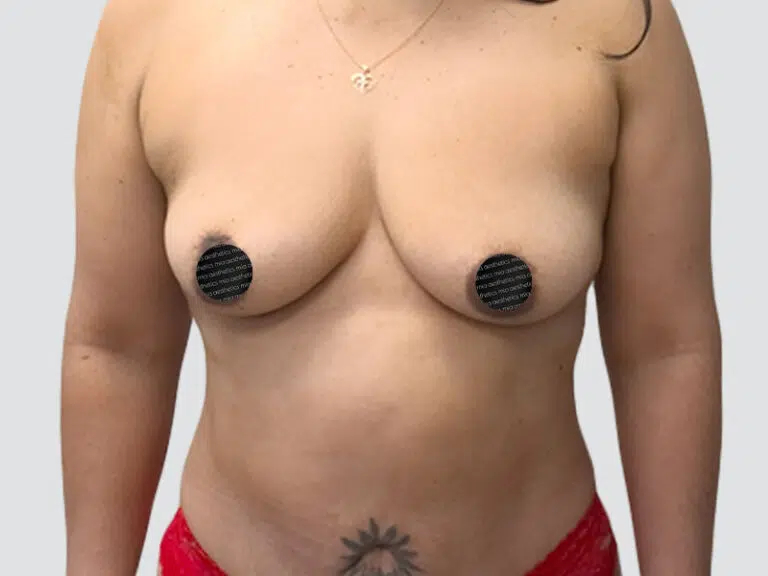 Breast Augmentation before photo – Mia Aesthetics