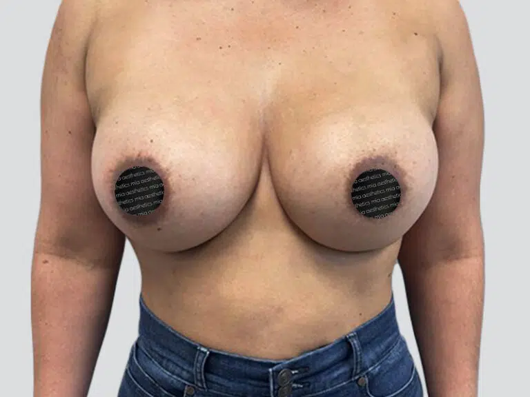 Breast Augmentation after photo – Mia Aesthetics