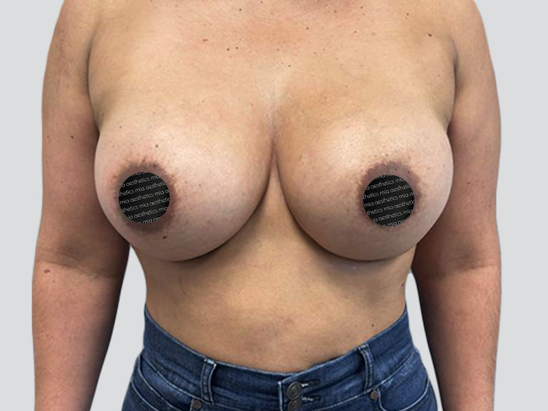 After Treatment – Case 2010