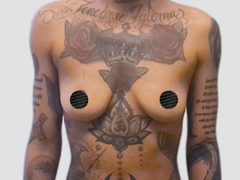 Before Treatment – Case 2013 – Breast Augmentation