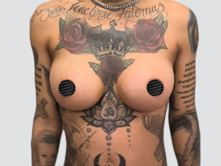 After Treatment – Case 2013 – Breast Augmentation