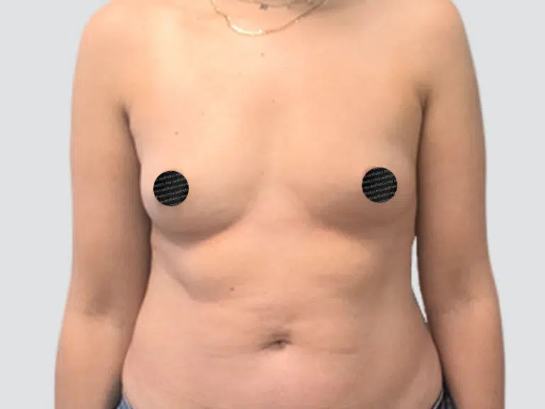 Breast Augmentation before photo – Mia Aesthetics