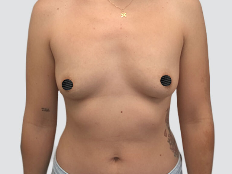 Before Treatment – Case 2015 – Breast Augmentation