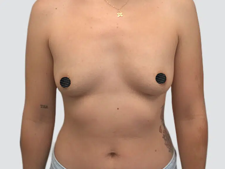 Breast Augmentation before photo – Mia Aesthetics