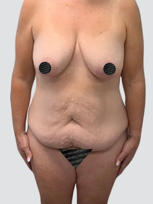 Tummy Tuck before photo – Mia Aesthetics