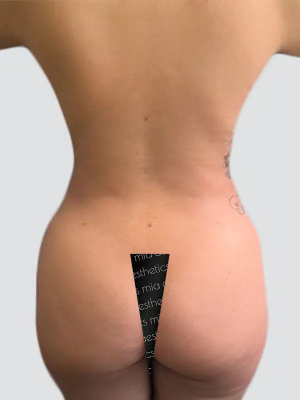 Lipo 360 after photo – Mia Aesthetics