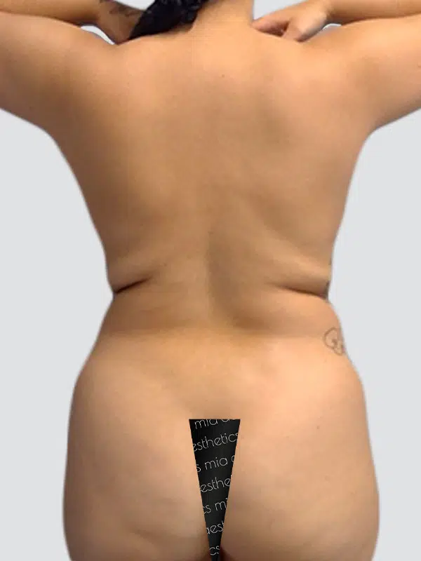 Lipo 360 before photo – Mia Aesthetics