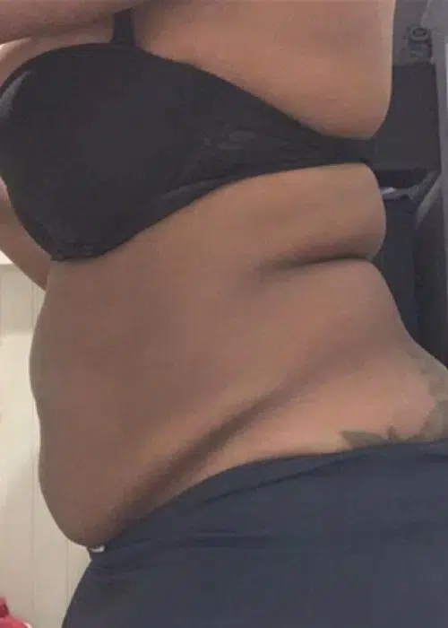 Before procedure