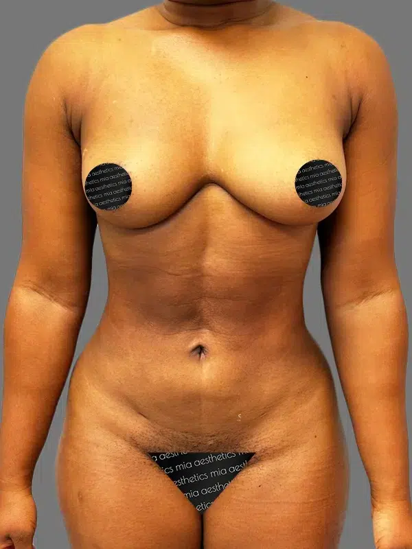 Lipo 360 after photo – Mia Aesthetics