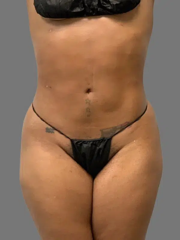 Lipo 360 after photo – Mia Aesthetics