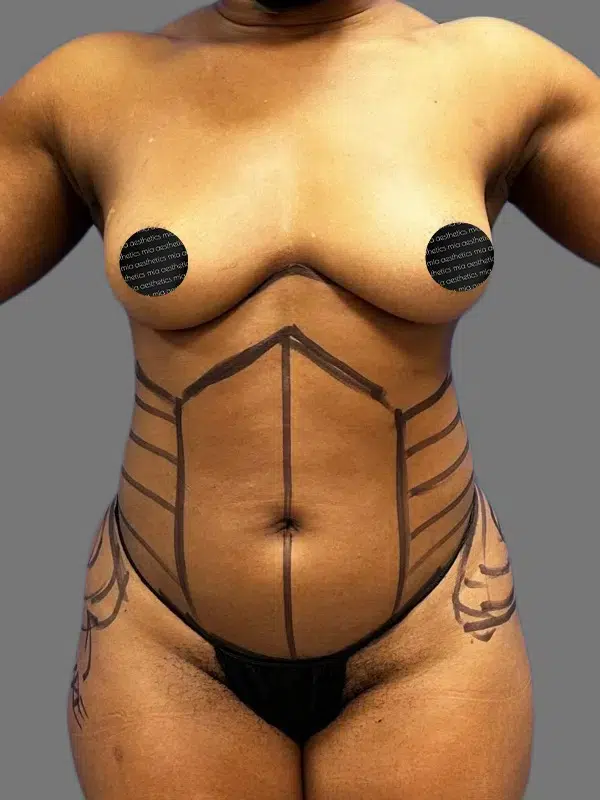 Lipo 360 before photo – Mia Aesthetics