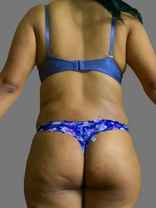 Lipo 360 before photo – Mia Aesthetics