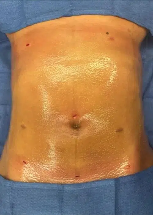 After procedure