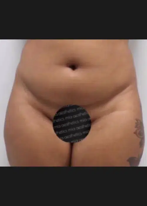 Before procedure