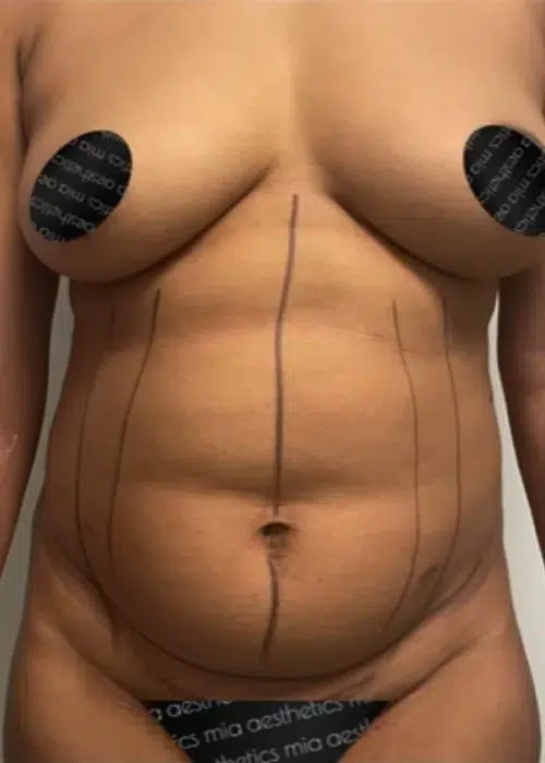 Before procedure
