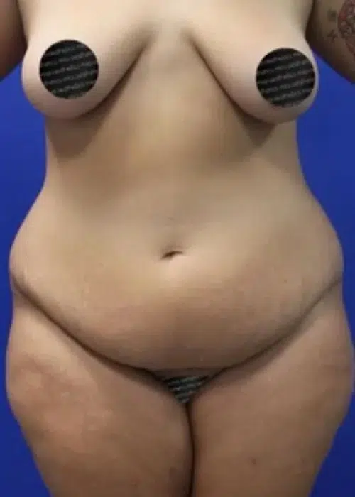 Before procedure