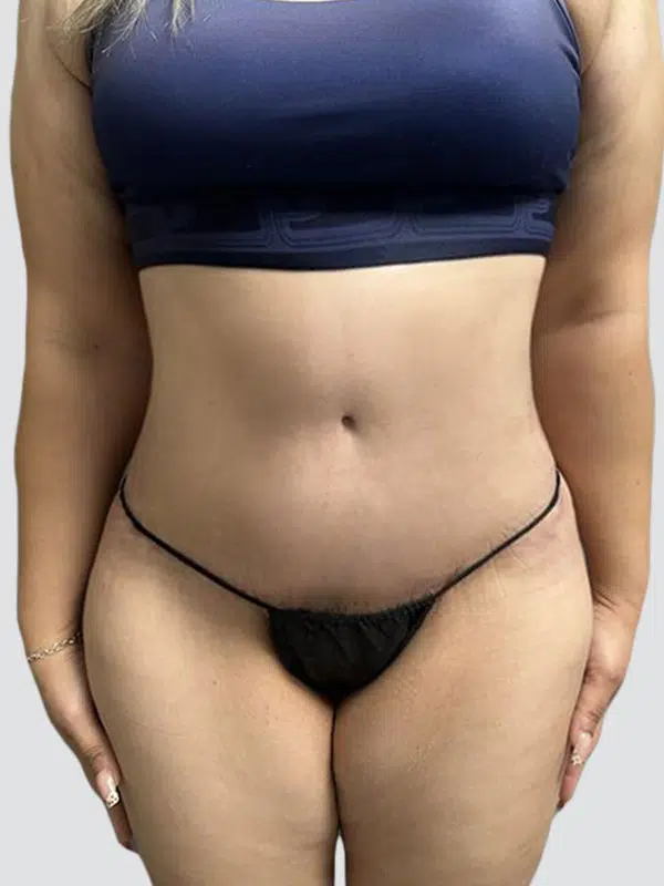 Tummy Tuck after photo – Mia Aesthetics