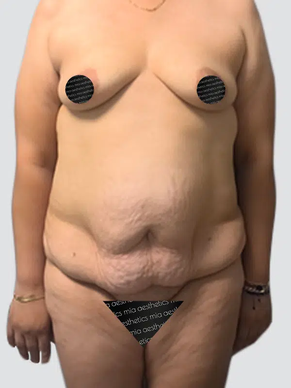 Tummy Tuck before photo – Mia Aesthetics