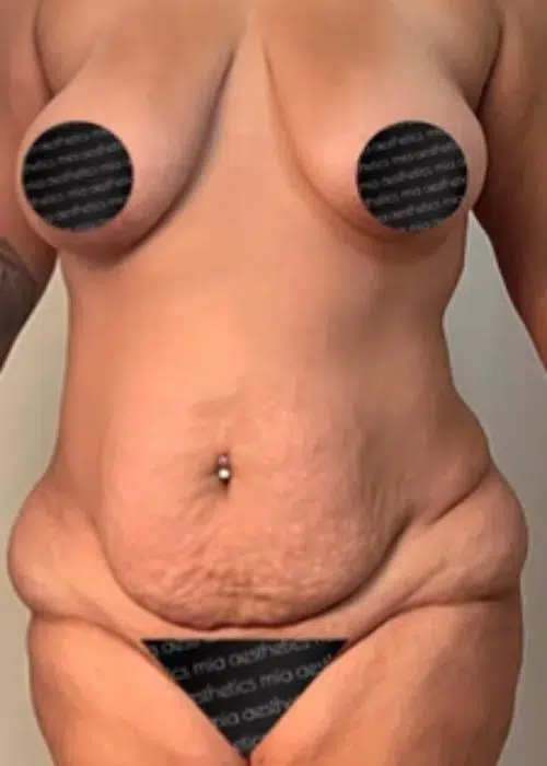 Before procedure