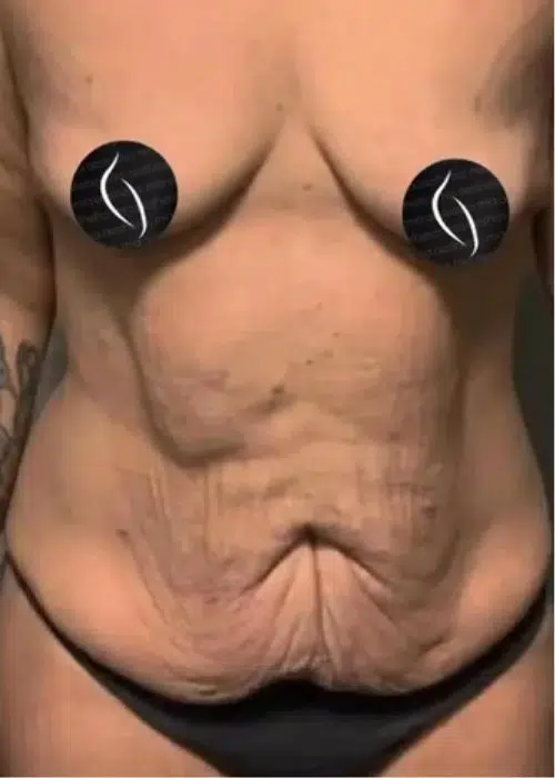 Before procedure