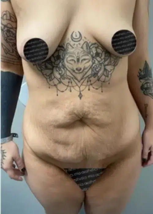 Before procedure