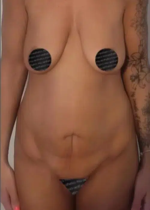 Before procedure
