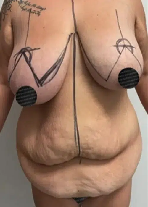 Before procedure