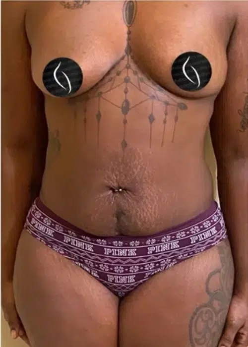 Before procedure