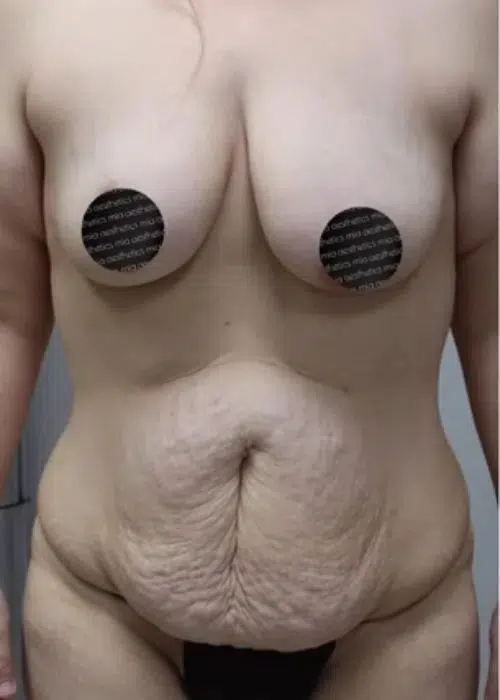 Before procedure