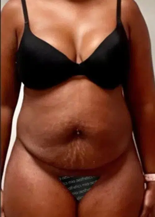 Before procedure