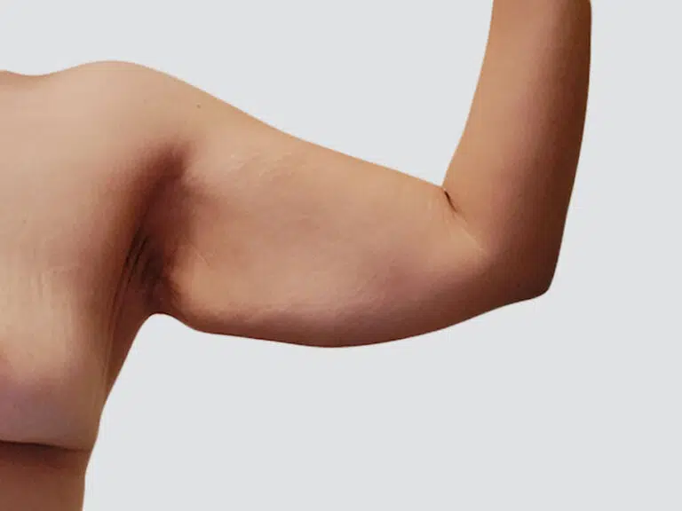 Arm Lift before photo – Mia Aesthetics