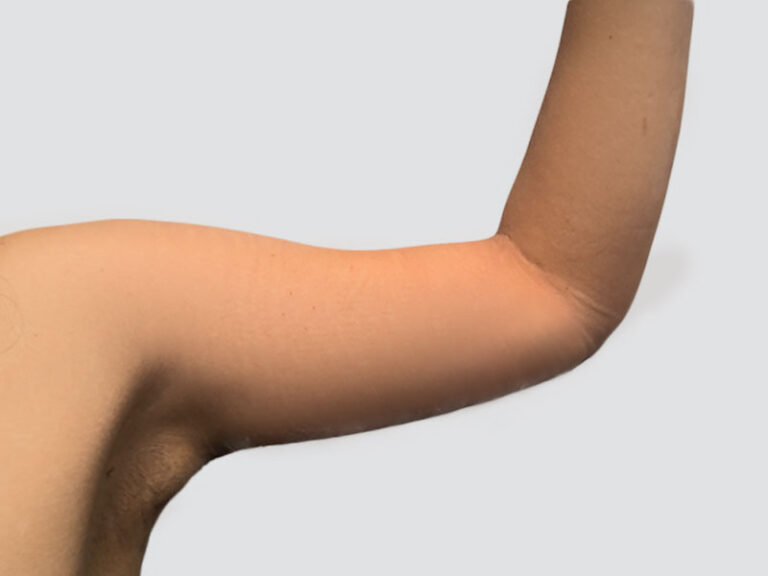 After Treatment – Case 6002 – Arm Lift