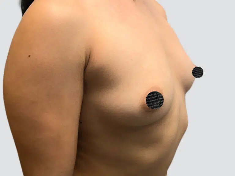 Breast Augmentation before photo – Mia Aesthetics