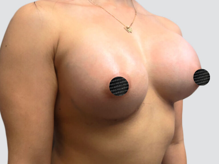 After Treatment – Case 2011