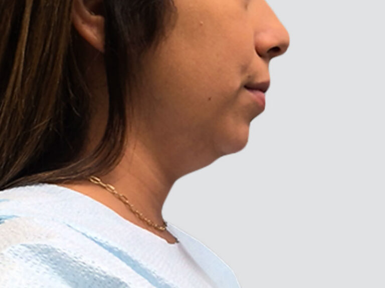 Before Treatment – Case 8000 – Chin Lipo
