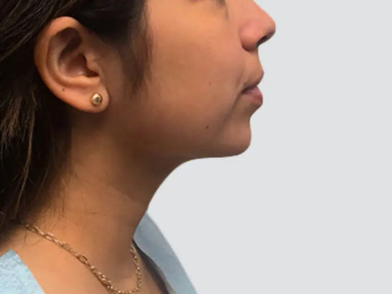Chin Lipo after photo – Mia Aesthetics