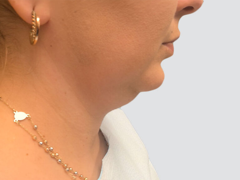 Before Treatment – Case 8001 – Chin Lipo