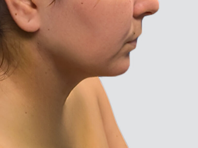 After Treatment – Case 8001 – Chin Lipo